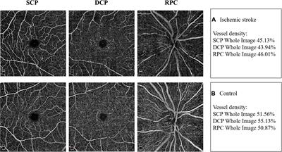 Retinal Neurovascular Changes in Patients With Ischemic Stroke Investigated by Optical Coherence Tomography Angiography